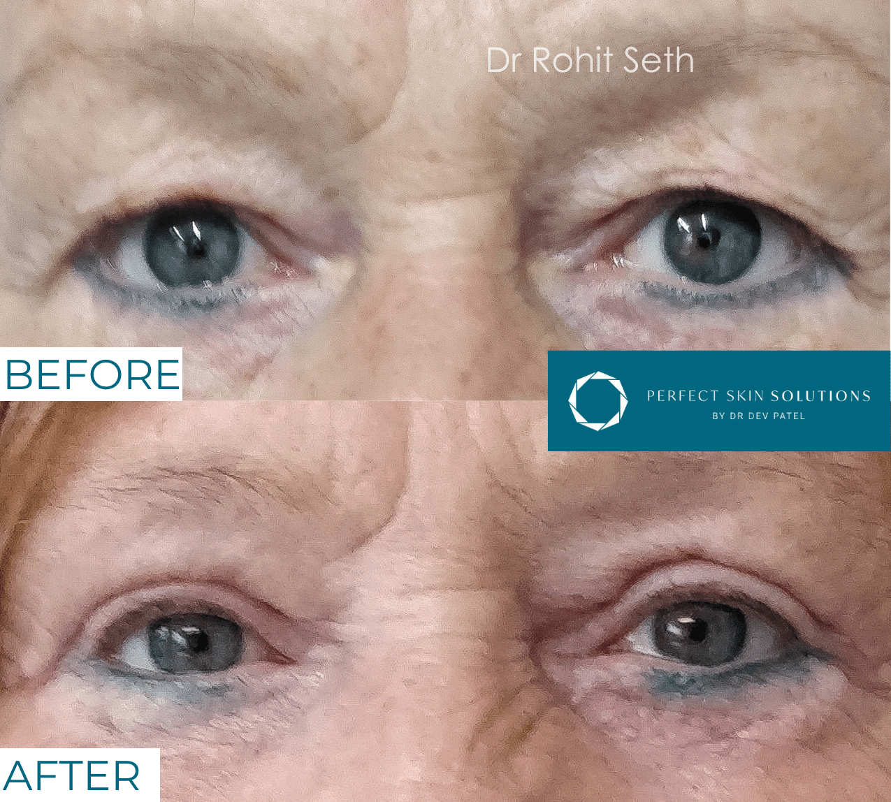 Before and after photo of eyes from blepharoplasty eyelid surgery woman