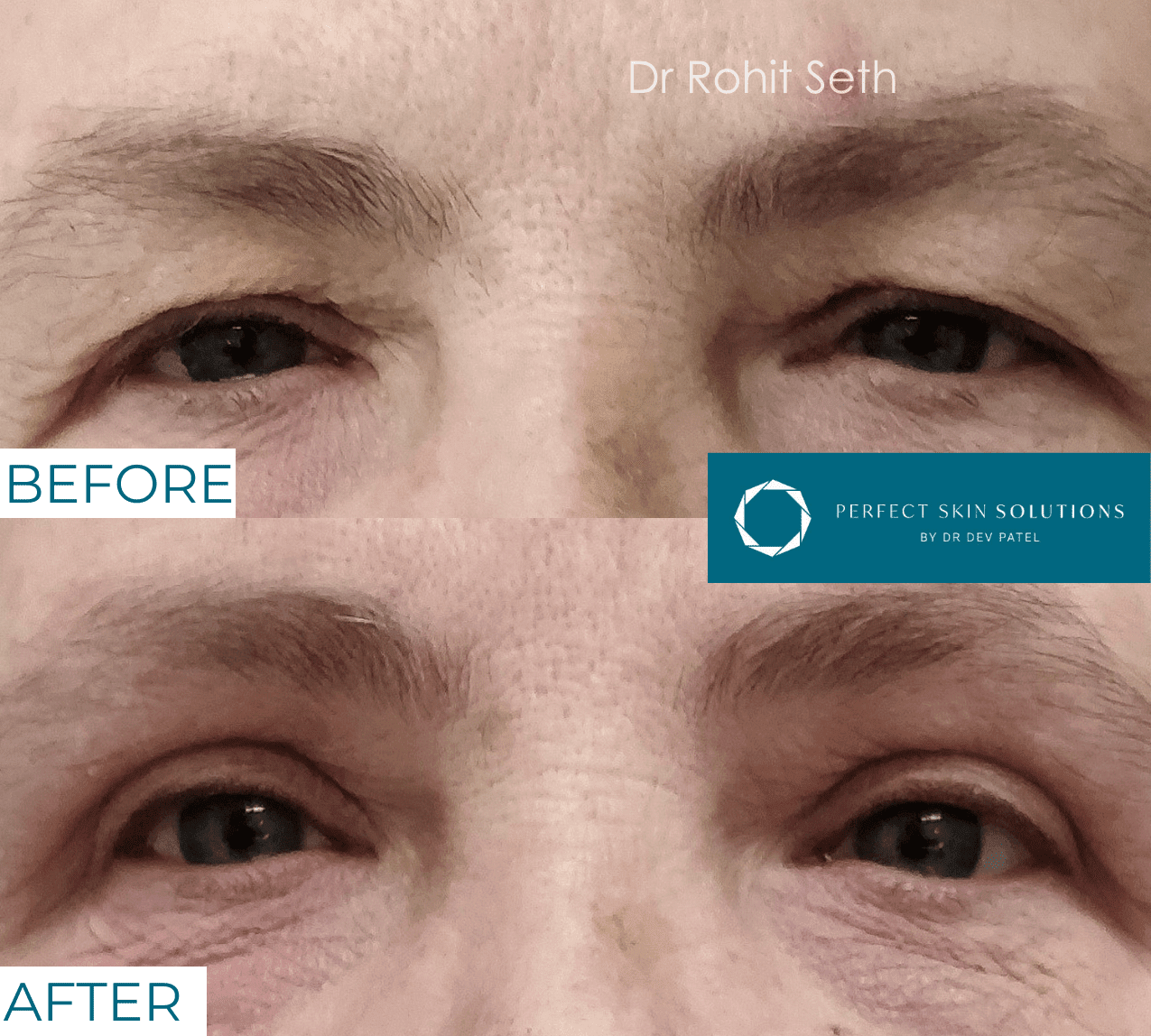 Before and after photo of eyes from blepharoplasty eyelid surgery man
