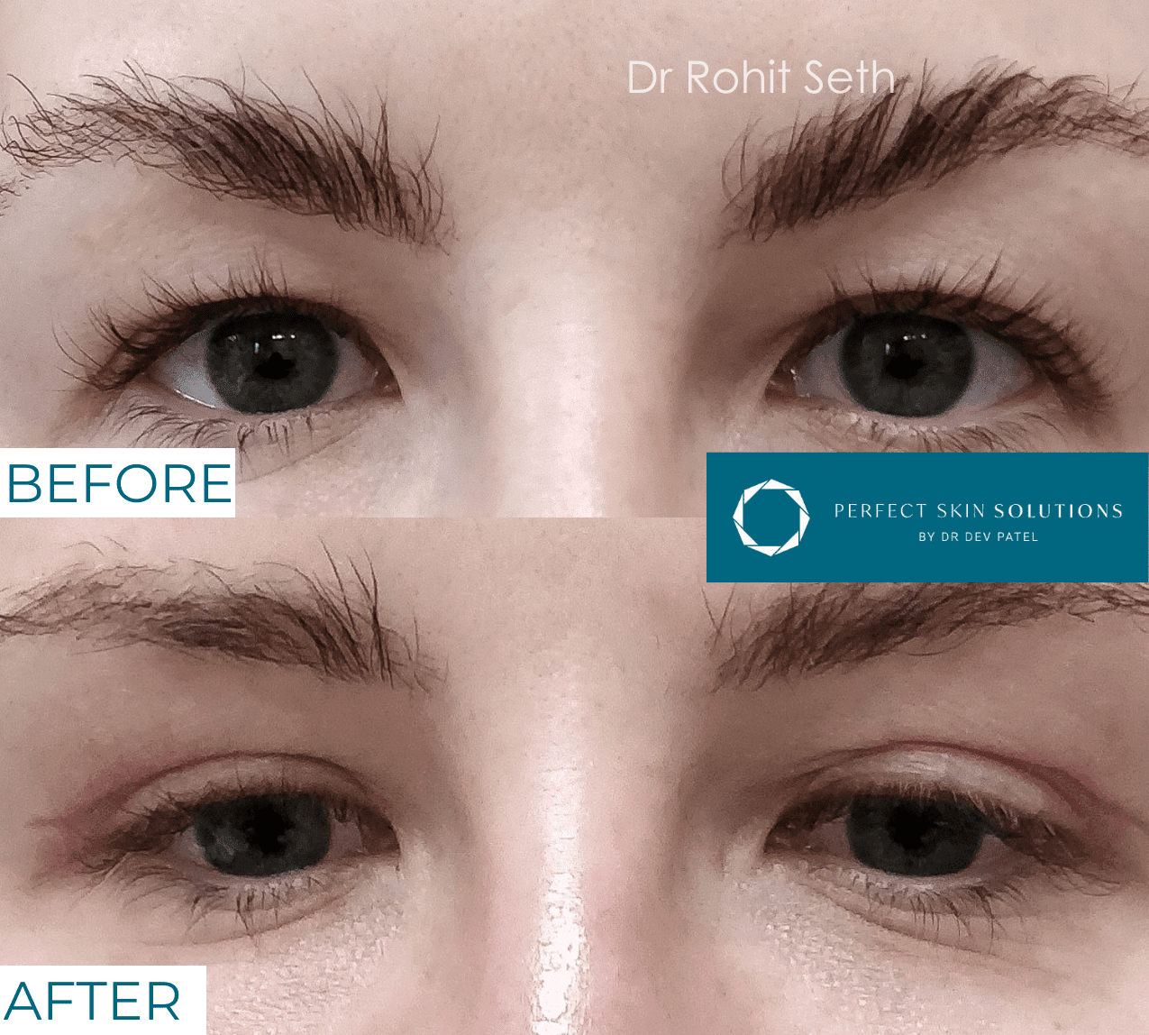 Before and after photo of eyes from blepharoplasty eyelid surgery woman