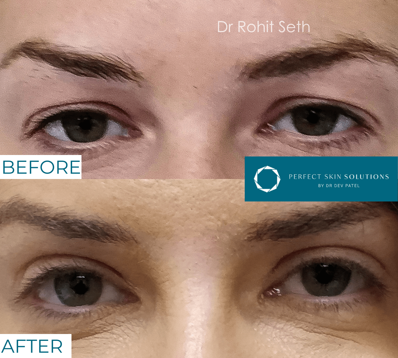 Before and after photo of eyes from blepharoplasty eyelid surgery woman