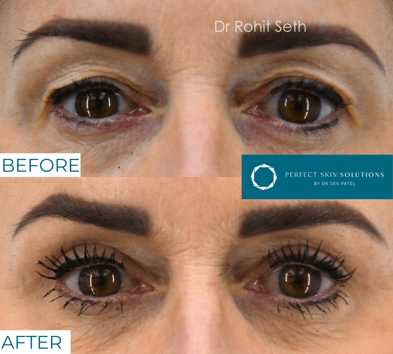 Before and after photo of eyes from blepharoplasty eyelid surgery woman