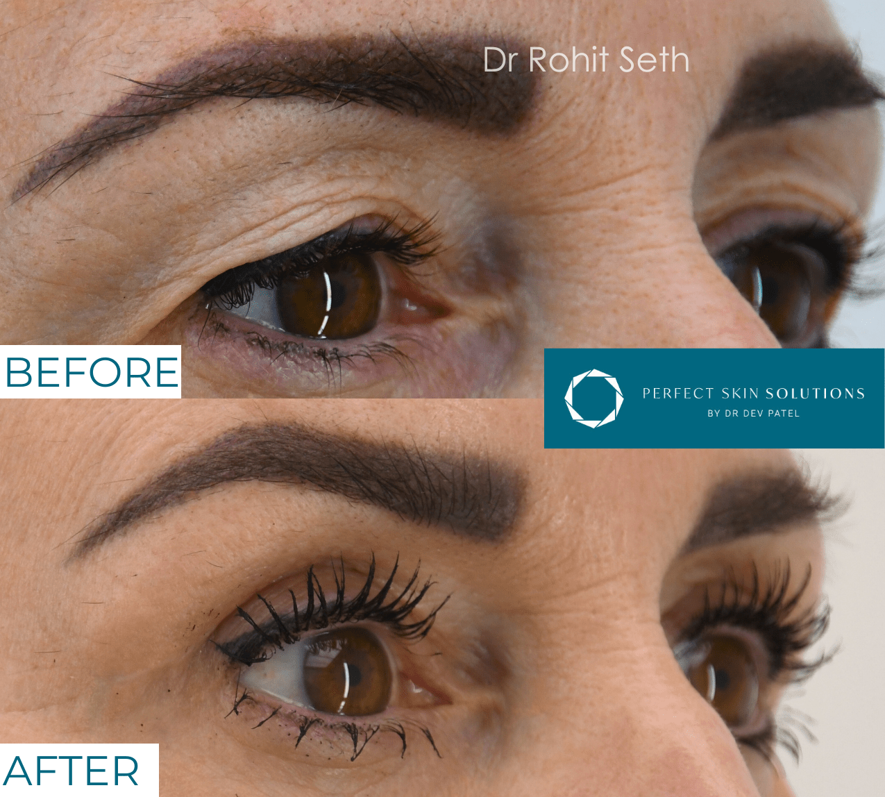 Before and after photo of eyes from blepharoplasty eyelid surgery woman side view