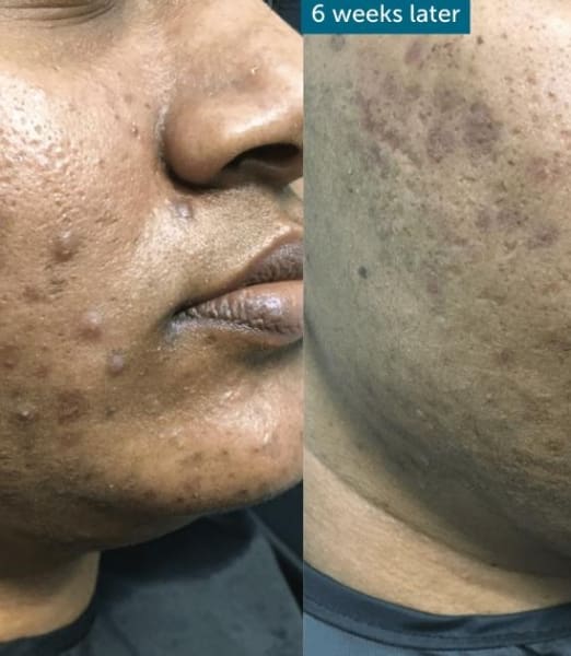 Best Facial Treatment for Acne: Why Choose Perfect Skin Solutions