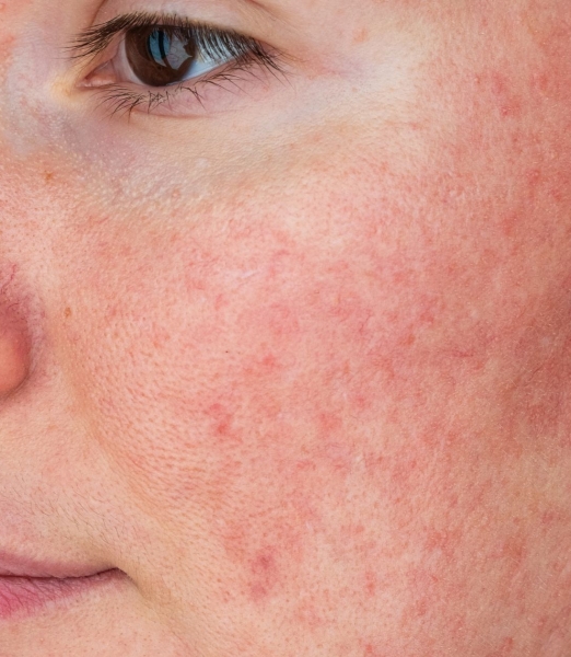 Lumecca for Rosacea
