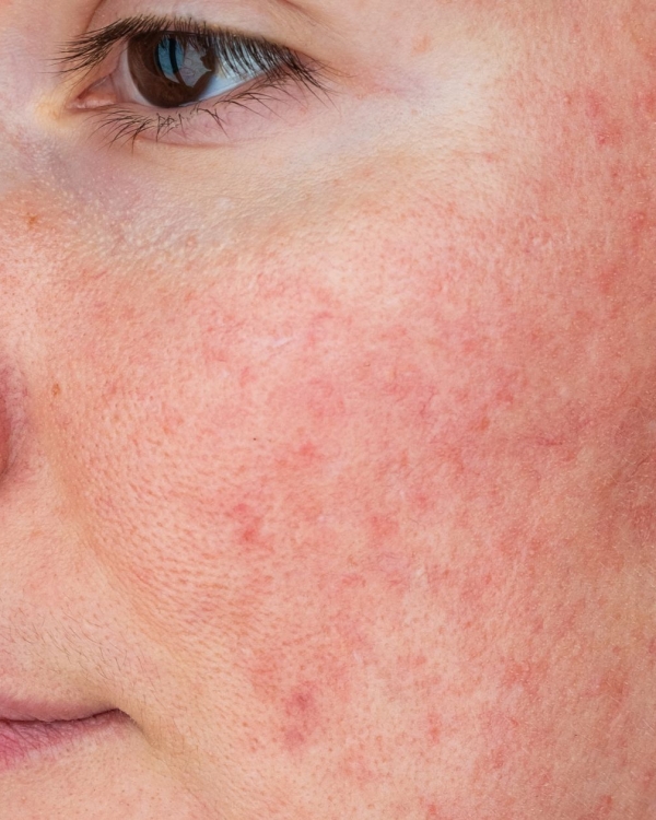 Lumecca for Rosacea