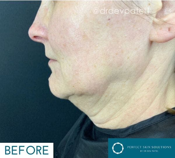 endodefine treatment before