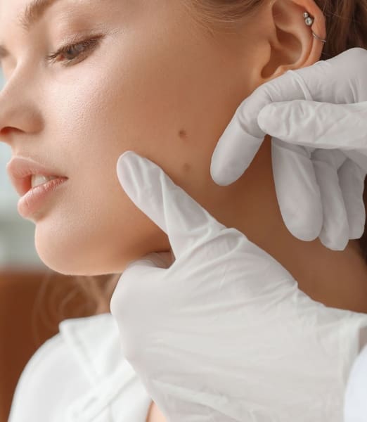 How to Get Rid of Flat Moles: A Complete Guide