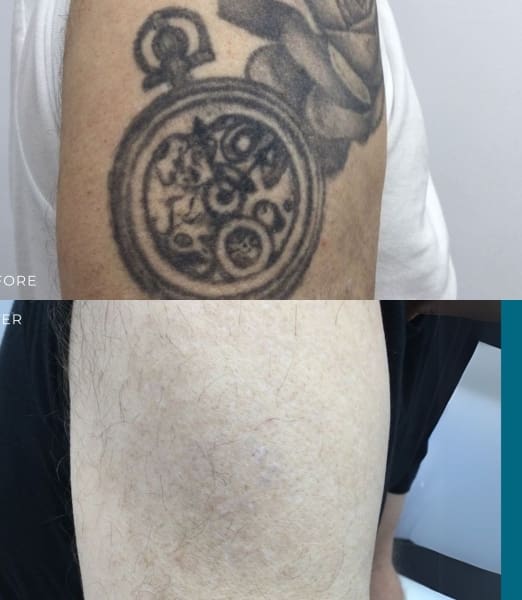 The Best Tattoo Removal Laser: Why Perfect Skin Solutions Chooses PicoMax