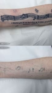 Tattoo removal before and after