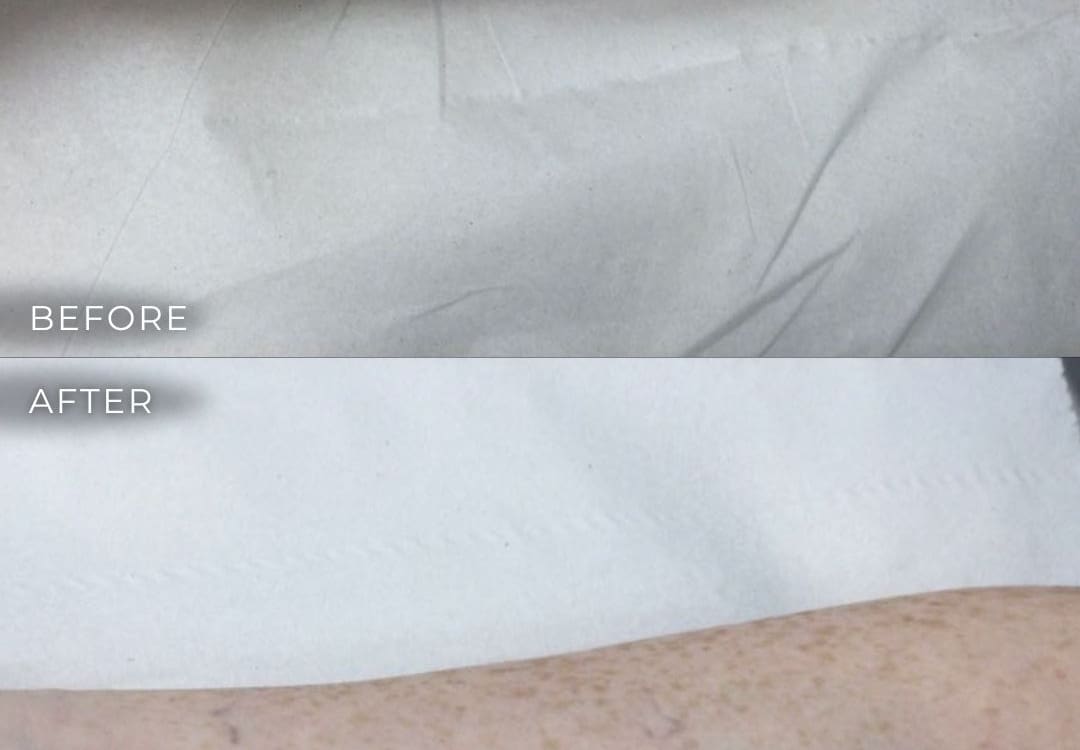 tattoo removal on arm