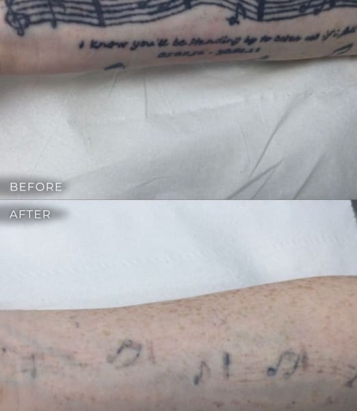 Everything You Need to Know About Getting Tattoos Removed