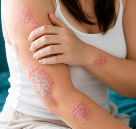 Struggling With Persistent Psoriasis Flare-Ups?