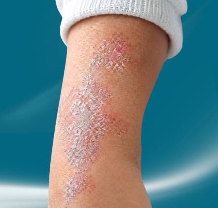 Struggling With Persistent Psoriasis Flare-Ups?