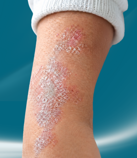 Struggling With Persistent Psoriasis Flare-Ups?