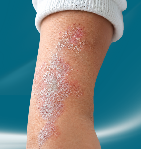 Struggling With Persistent Psoriasis Flare-Ups?