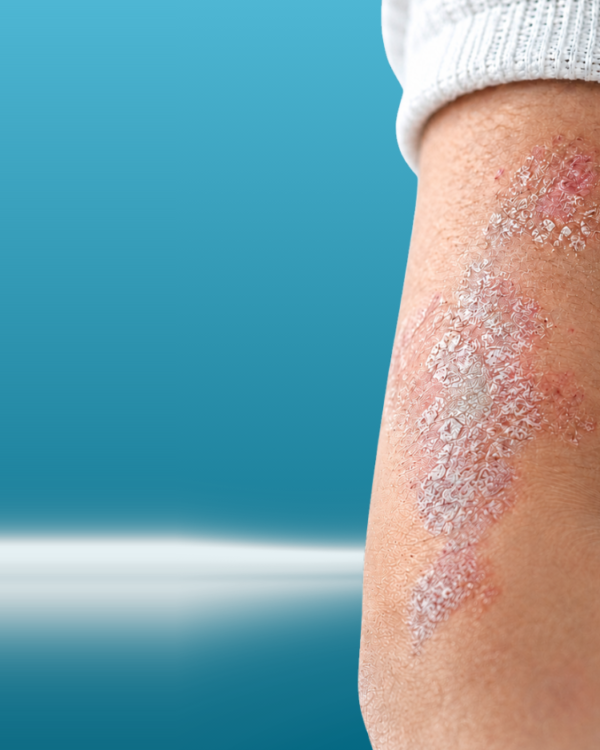 Struggling With Persistent Psoriasis Flare-Ups?